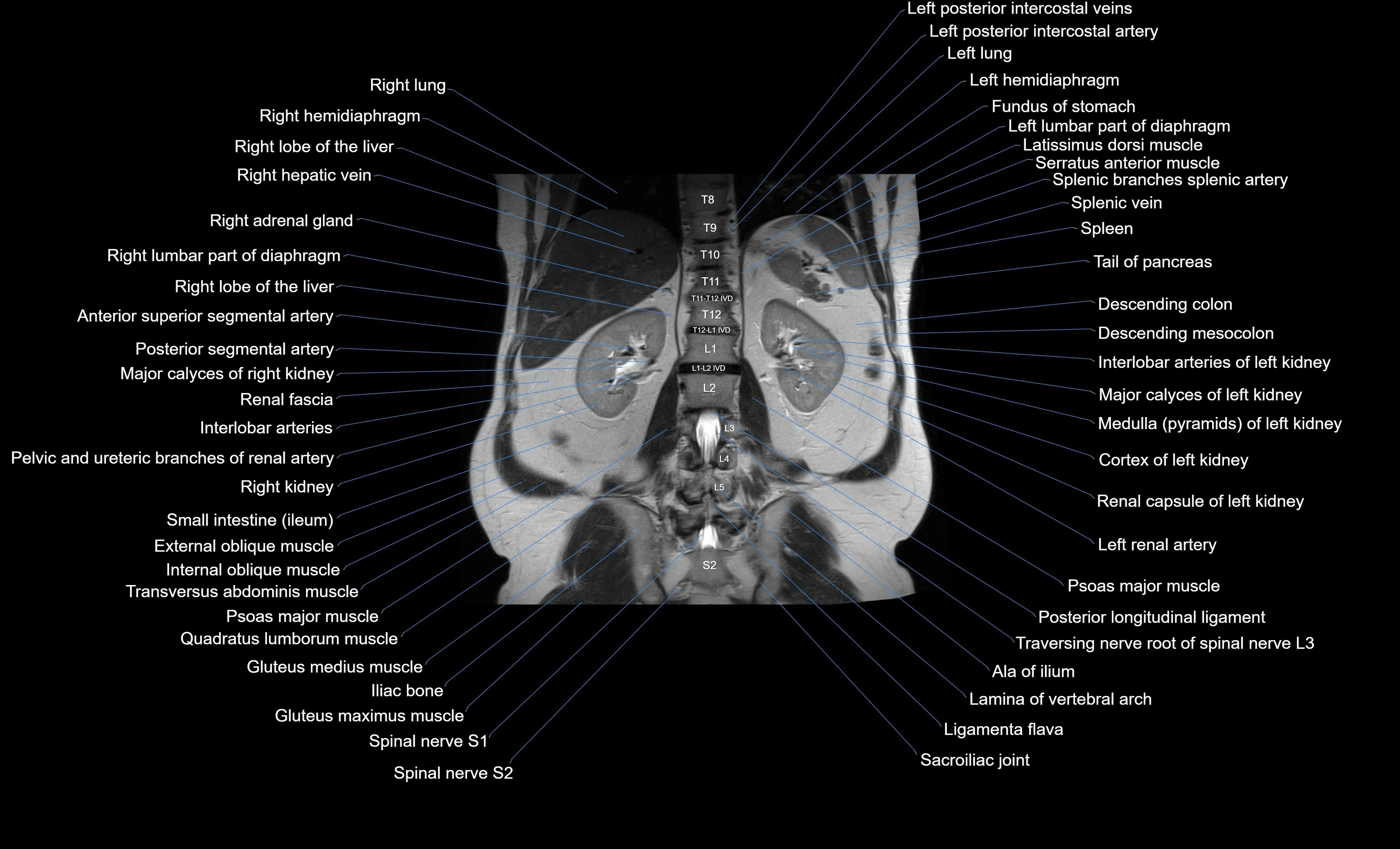 MRI Abdomen coronal labelled cross sectional anatomy radiology  image-img-00001-00041.webp
